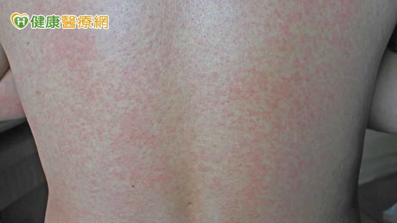 紅斑性狼瘡冬季容易惡化？中醫師提醒　飲食與循環調理重點