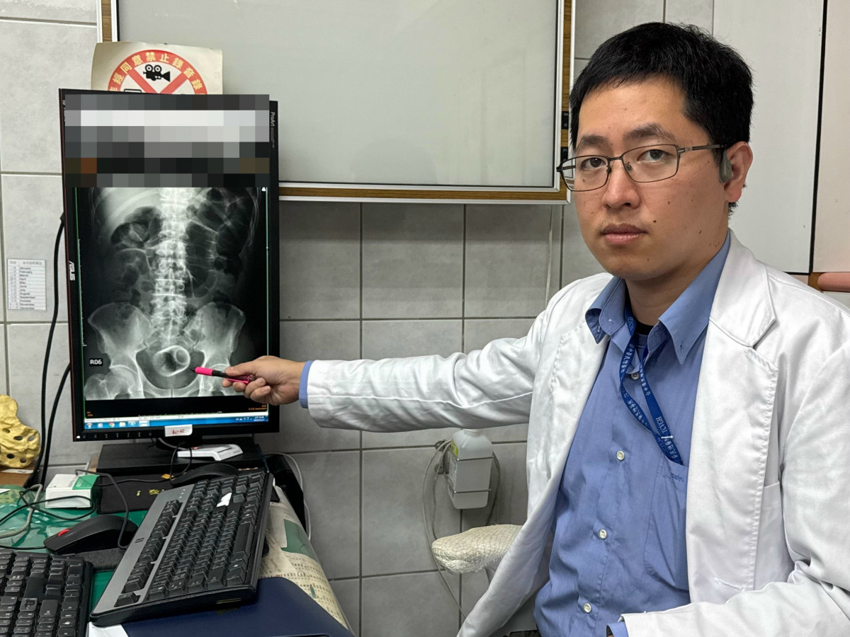 男3天無法嗯嗯　竟是瓷杯塞「菊花」惹禍！　醫傻眼急開刀取出